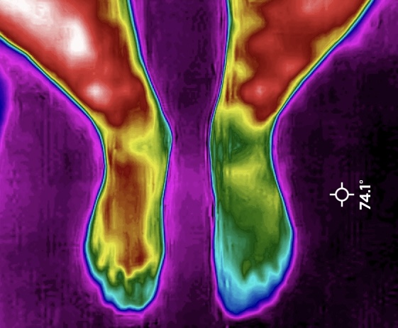 Peripheral Neuropathy
