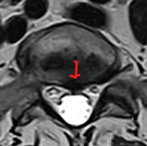 McKimm Pre Axial MRI
