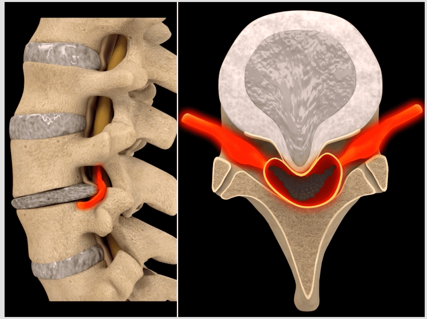 SpineWell Central Disc Herniation () SpineWell Central Disc Herniation ()